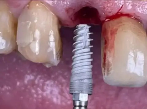Single anterior tooth