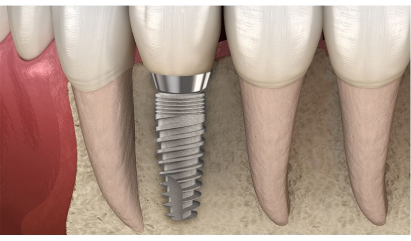 Osseointegration and the factors that affect it