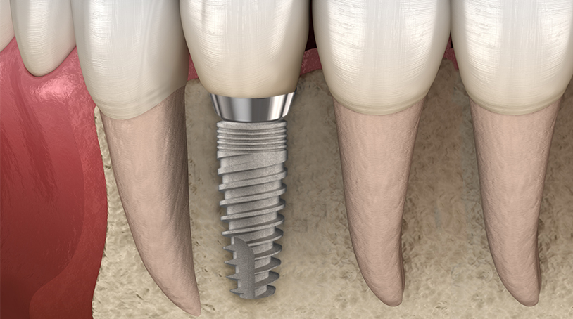 Osseointegration and the factors that affect it